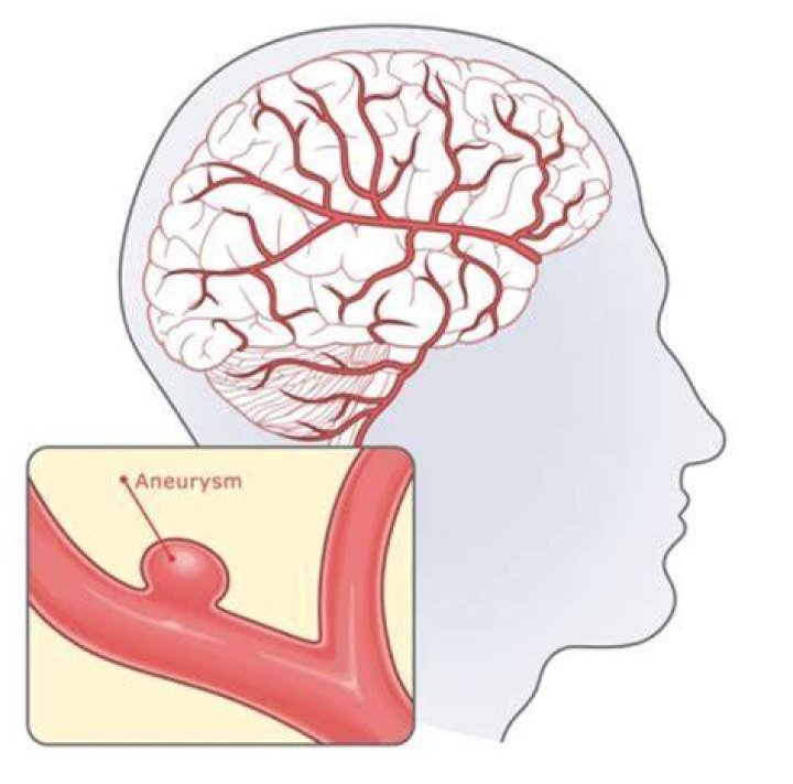 Can you get an aneurysm from whiplash?