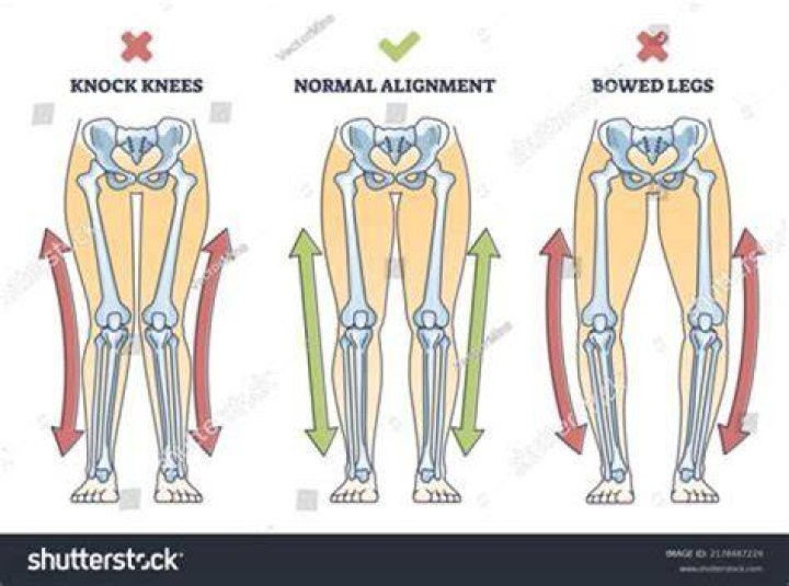Does early walking cause bow legs?
