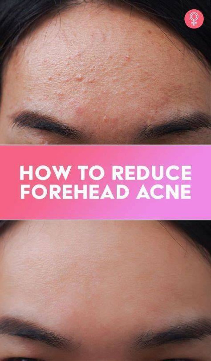 How do I stop forehead acne?