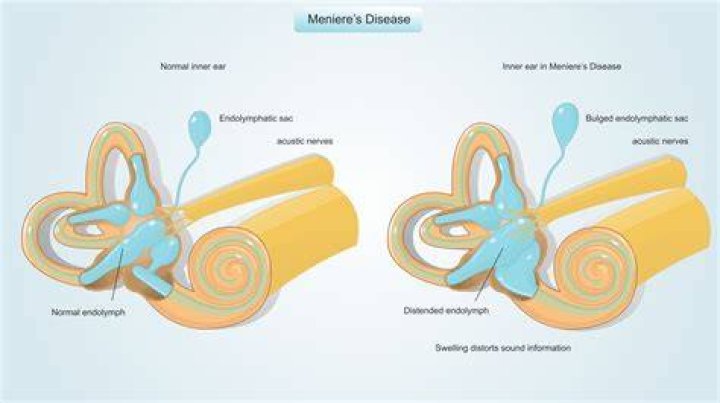 What can you not do with Meniere's disease?