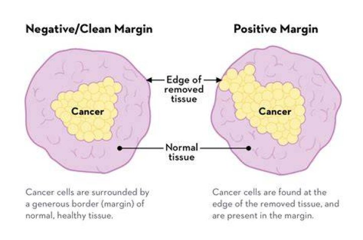 What does positive margins after LEEP mean?