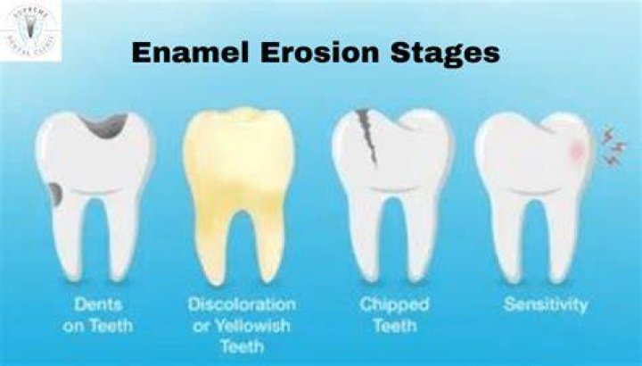 Why am I losing enamel on my front teeth?